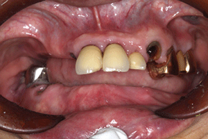 入れ歯の症例